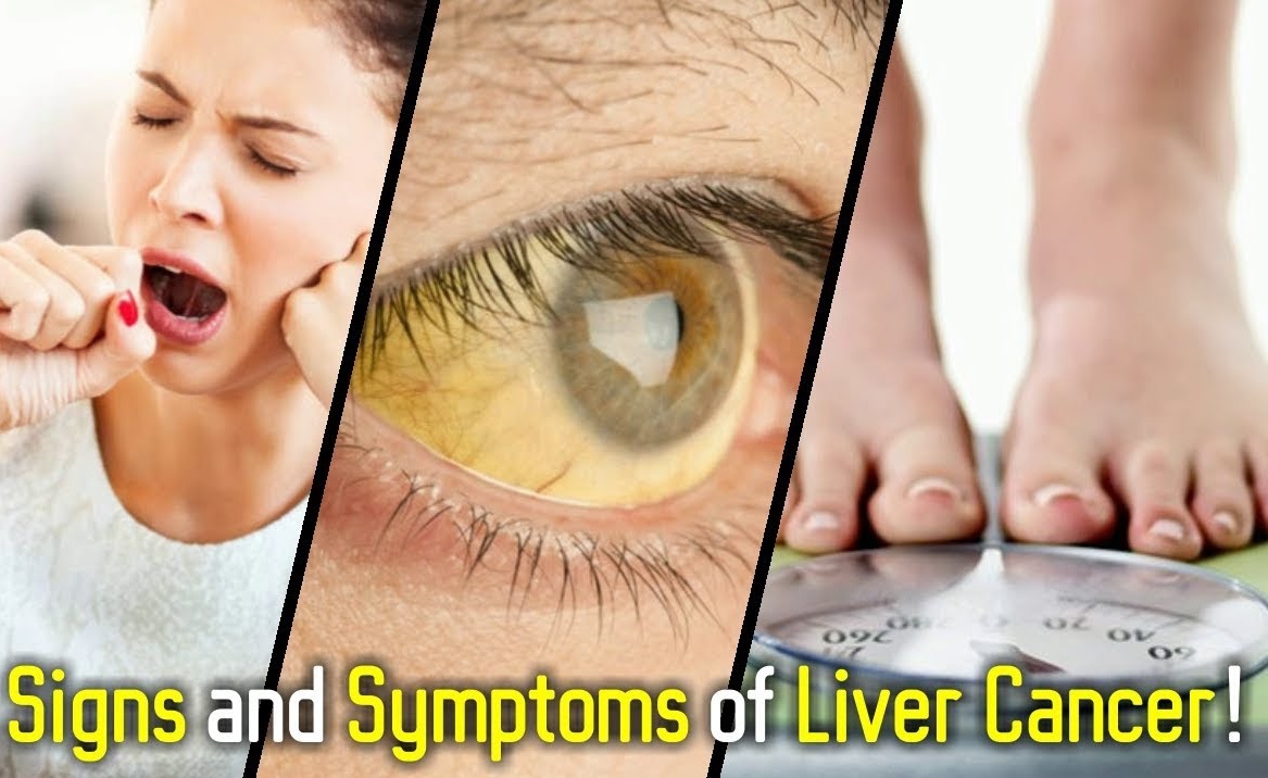 Liver Cancer Signs & Symptoms